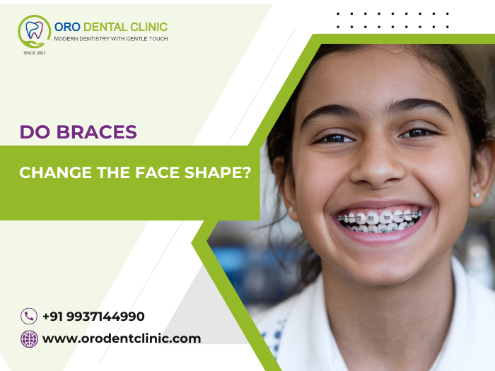 Do braces change the face shape?