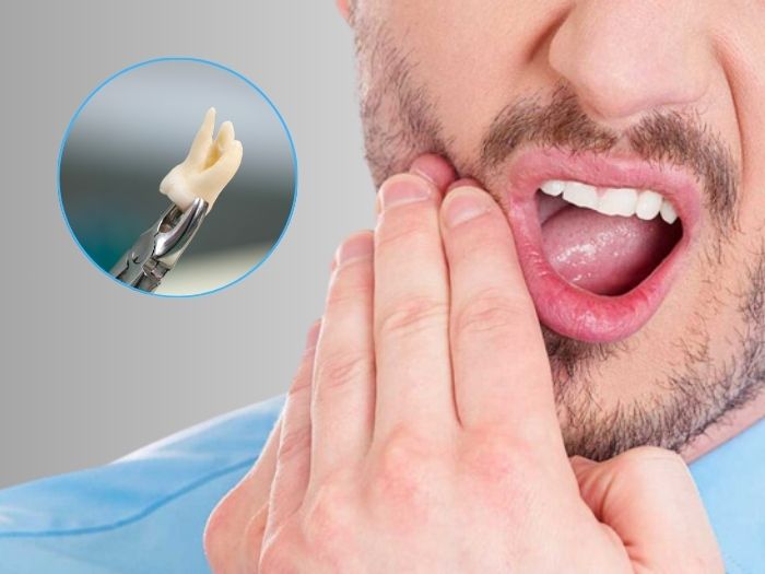 How Long Does It Take to Heal After Wisdom Tooth Removal