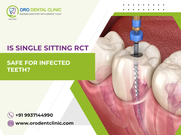 Is Single Sitting RCT Safe For Infected Teeth?