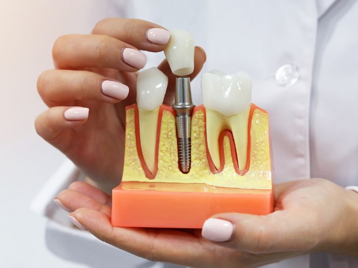 Things to Consider Before Taking Dental Implants Treatment in Sambalpur