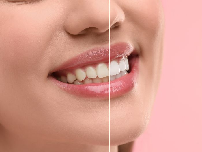 Tips to Avoid Stained Teeth Keeping Your Smile Bright
