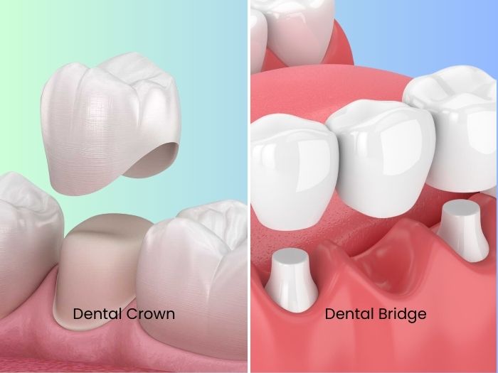 Why Should You Consider Dental Crowns Bridges Treatment